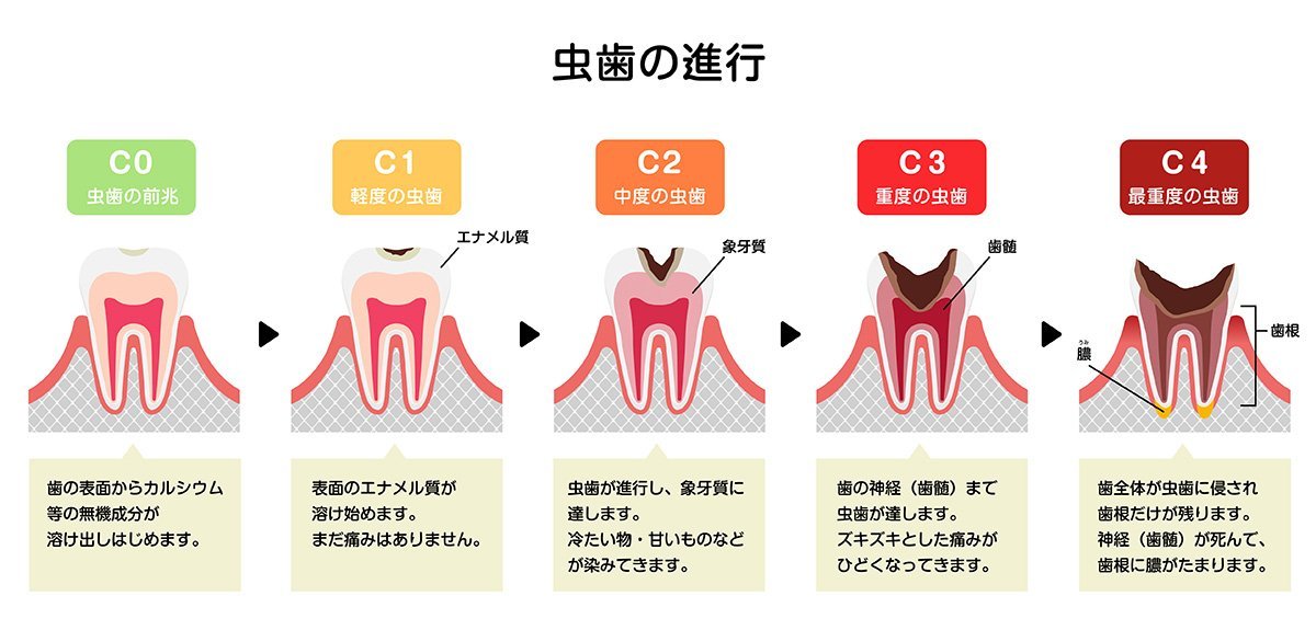 むし歯の治療イメージ